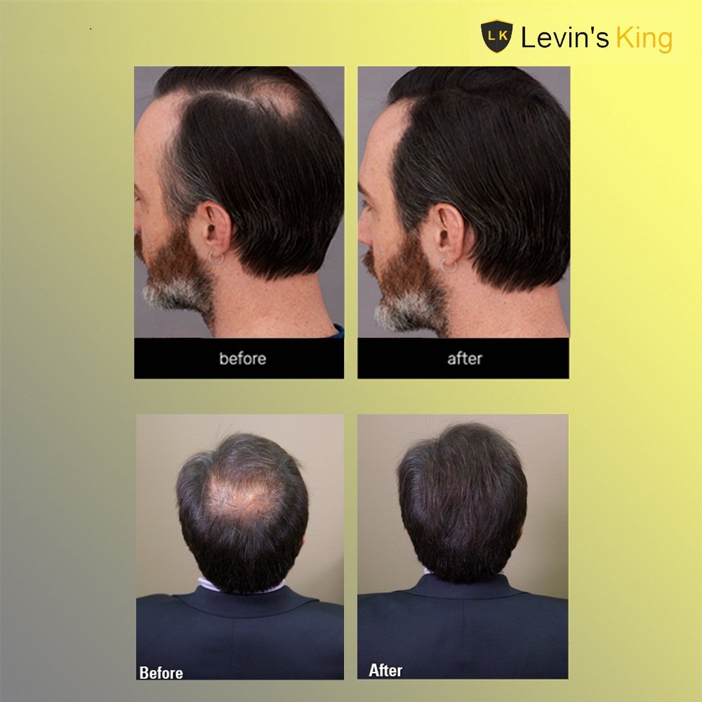 Levins King Hair Building Fiber, Hair fibre Concealer Refill Pack Use For All Hair fiber like Caboki etc (Dark Brown) (Refill Pack of 2 (50g))